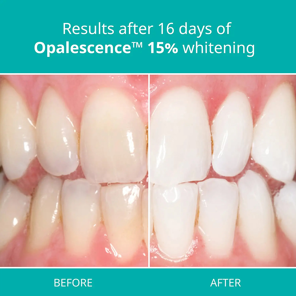Opalescence Professional White - Teeth Whitening Gel Opalescence avaliação e preço