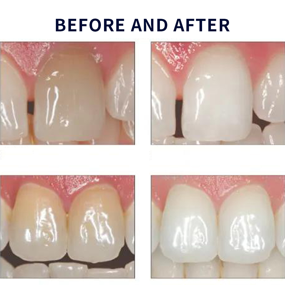 Opalescence Whitening 20% PF 2 - Teeth Whitening Home Kit avaliação e preço