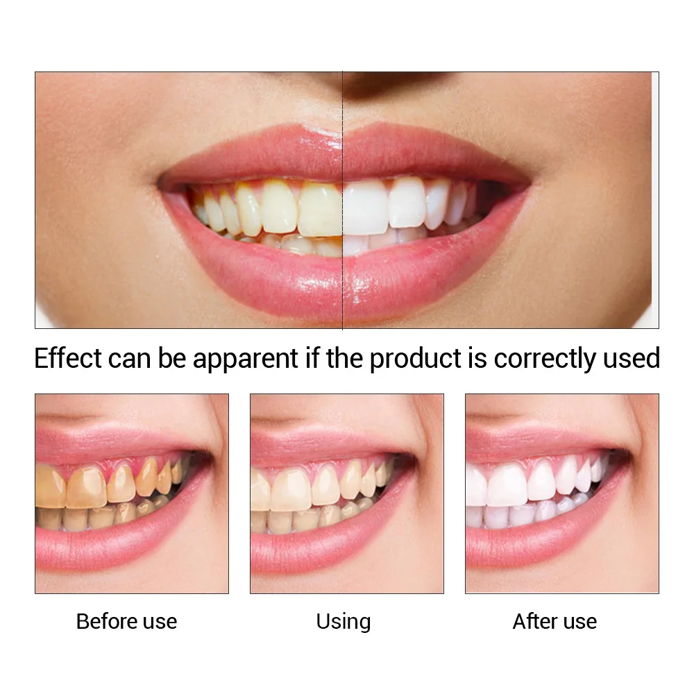 FTEENPLY Teeth Whitening Essen - Teeth Whitening Serum avaliação e preço