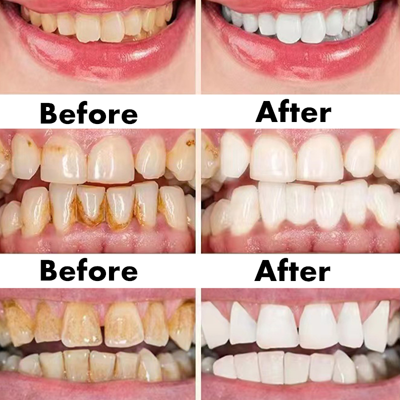 Teeth Whitening Pen Dental Ess - Teeth Whitening Serum avaliação e preço
