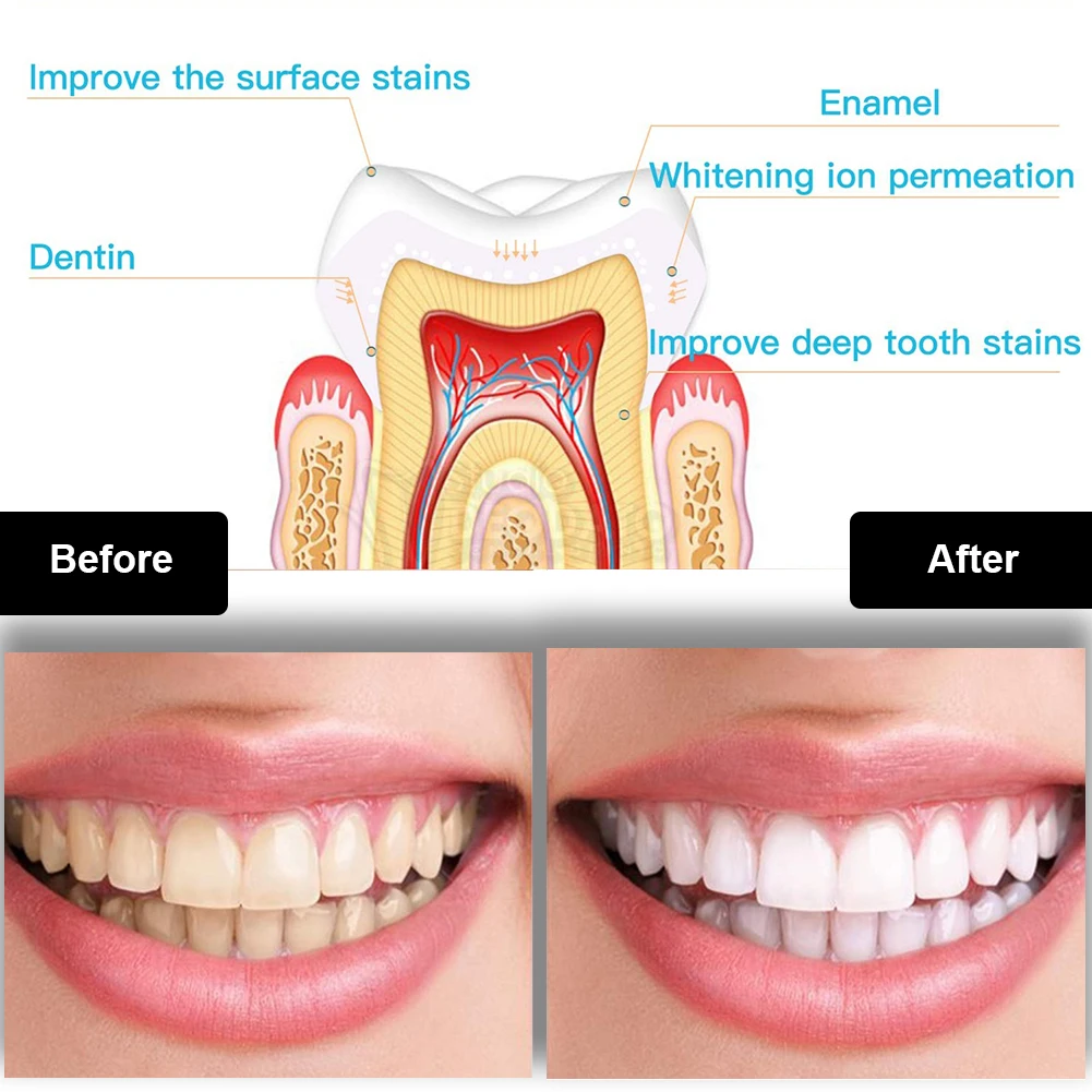 Dental Teeth Whitening Kit Min - Teeth Whitening Singapore avaliação e preço